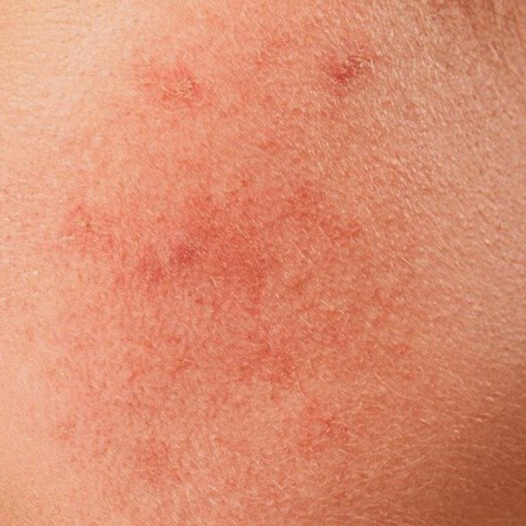 Does tretinoin actually reduces acne?